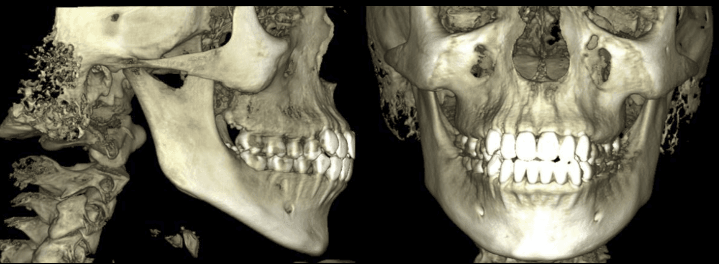 Reconstrucción tridimensional de un estudio Cone Beam CT dental